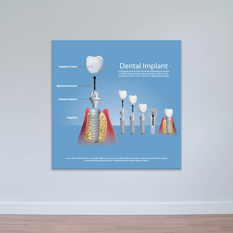 Tranh nha khoa hình ảnh răng sứ "Dental Implant" | Tranh treo tường phòng răng W7076
